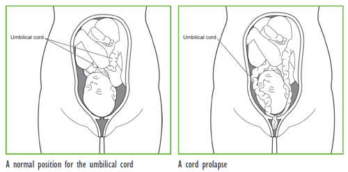 Prolapse