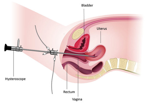 A hysteroscope being used to examine the cervix