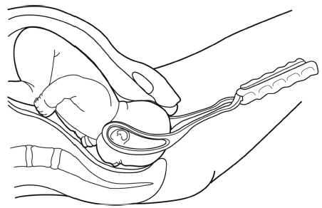 Assisted Vaginal Birth Ventouse Or Forceps Rcog Assisted Vaginal Birth Ventouse Or Forceps Rcog